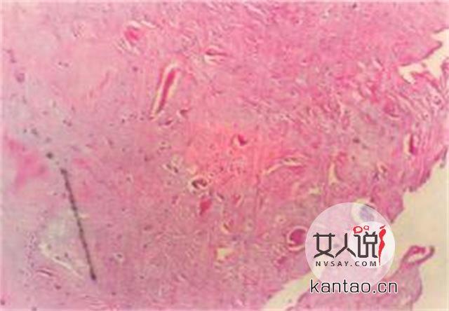 滴虫性阴道炎听起来是个很可怕的疾病,正如其名,滴虫性阴道炎是由