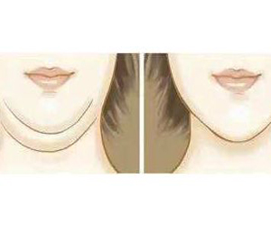 如何消除双下巴？三种方法让你的下巴恢复紧致