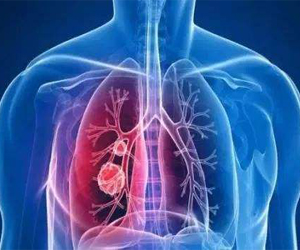 英国新技术可较早检测出肺癌