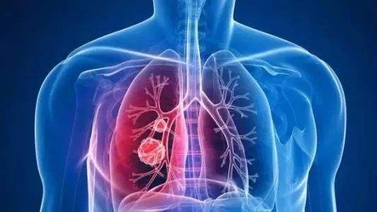 英国新技术可较早检测出肺癌