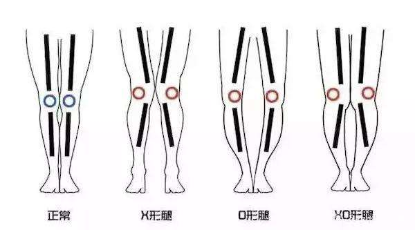 X型腿怎么矫正