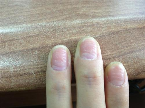 指甲表面凹凸不平的原因与解决方法