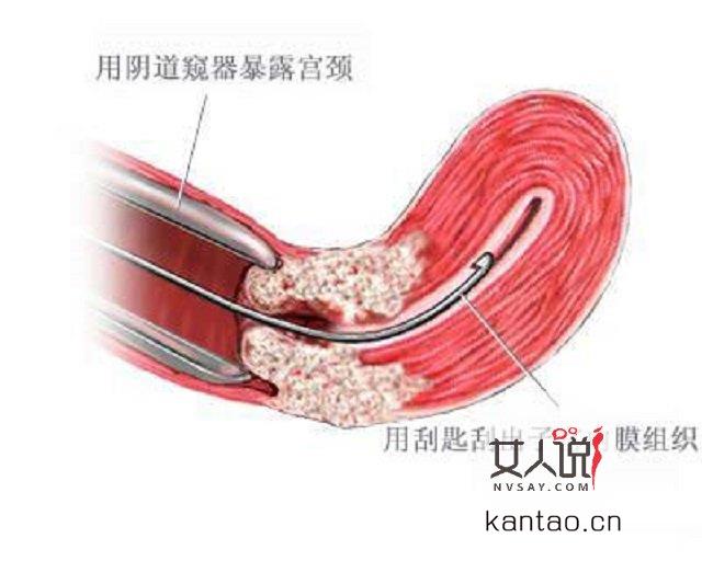 药流人流跟人工流产的区别?医学科普大讲堂开课啦!