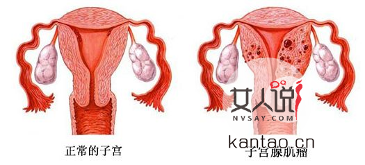 子宫肌瘤是怎么引起的,得子宫肌瘤有何症状?